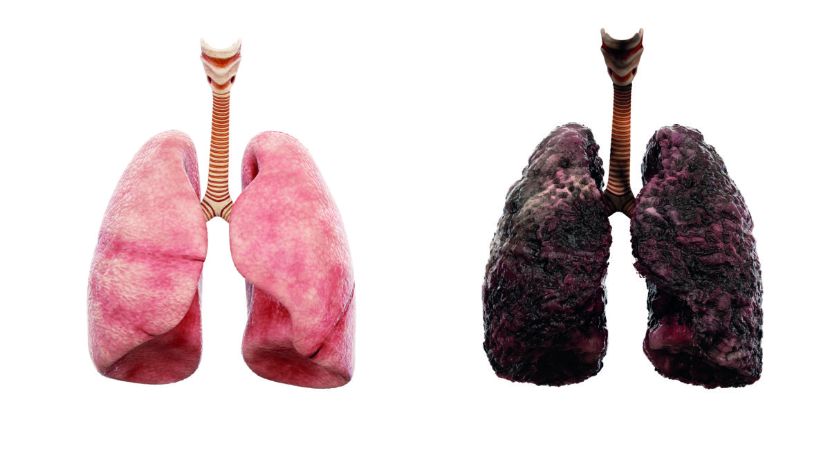 healthy lungs and disease lungs on white isolate. Autopsy medical concept. Cancer and smoking problem